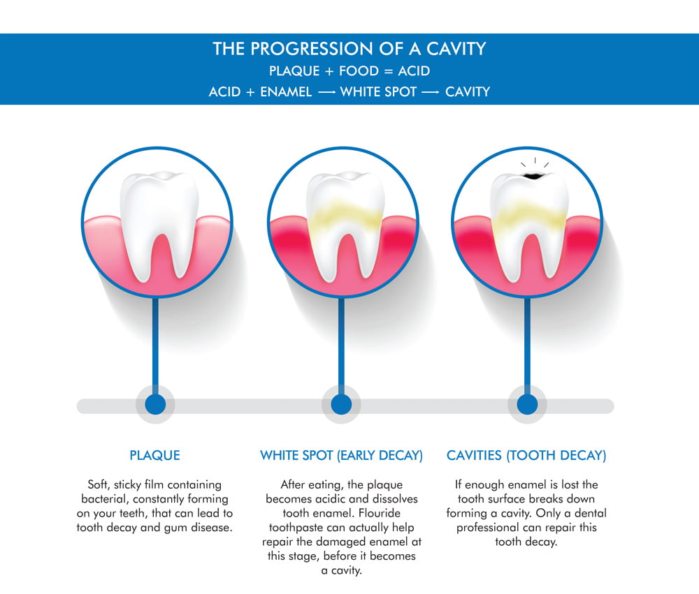 DentalPearls-infographics-cavity