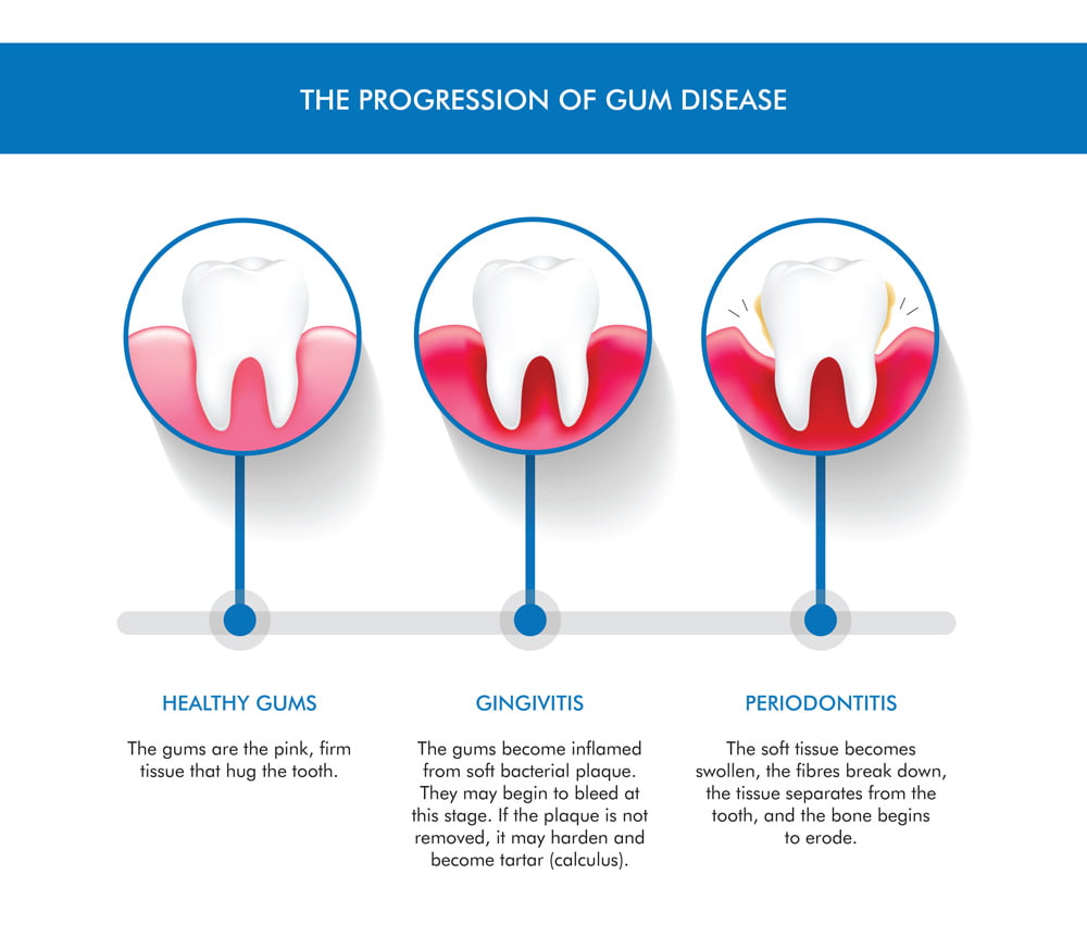 DentalPearls-infographics-gumdisease